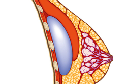 Implantat hinter dem Brustmuskel