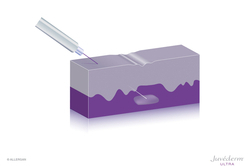 Dadurch wird die Falte aufgefüllt - der Effekt ist sofort sichtbar. 
